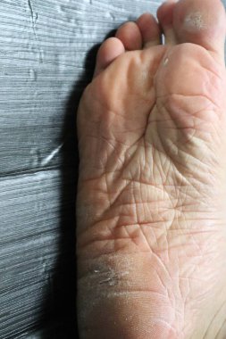 Baş parmağında su toplamış.