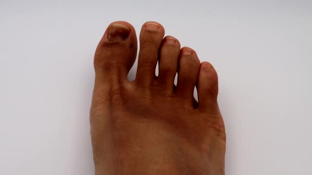 脚趾甲受了伤的人 — 图库视频影像