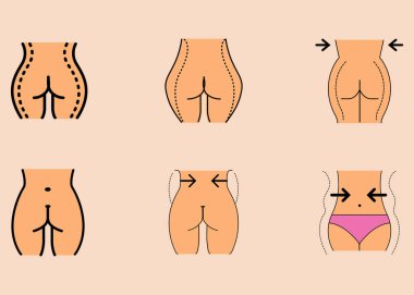 Kalça büyütme ameliyatlarının farklı türlerini tasvir eden altı çizim. Yağ aldırma, implantlar ve yağ nakli gibi..