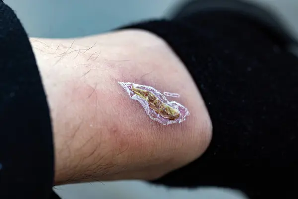 Bileğin yanındaki yara kabuğu.