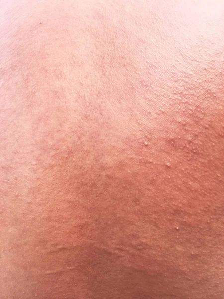 Hautausschlag Bei Empfindlicher Haut Oder Hautproblem Mit Allergischem Ausschlag — Stockfoto