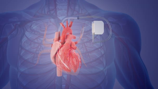 Állandó Pacemaker Implantátum Orvosi Koncepció — Stock videók