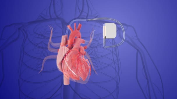 Stała Koncepcja Medyczna Implantu Rozrusznika Serca — Wideo stockowe