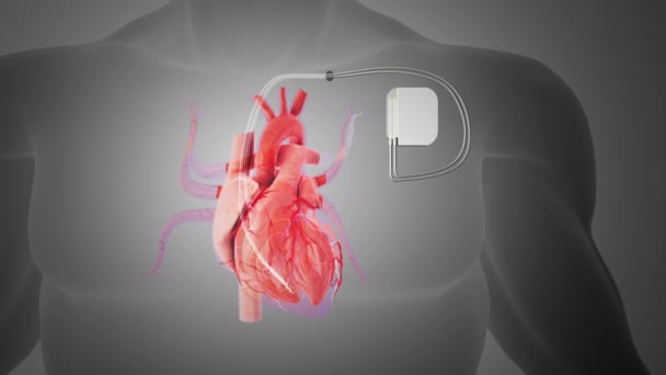 埋め込まれたペースメーカーシステムの心臓 — ストック動画