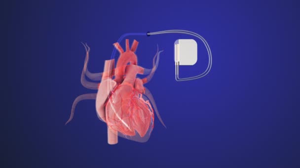 心拍波のラインが付いている心臓ペースメーカーの人工心拍 — ストック動画