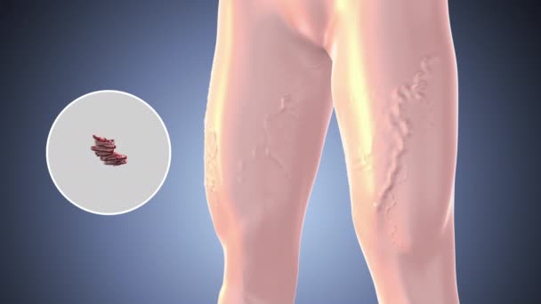 ヴァリクソース静脈を有する足の太ももも 医療コンセプト — ストック動画