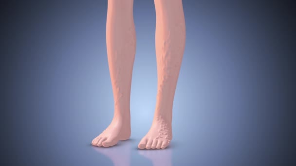ヴァリコース静脈および足の病気 — ストック動画