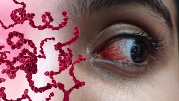 Глаз Бактериальным Гнойным Конъюнктивитом Известным Розовый Глаз — стоковое видео