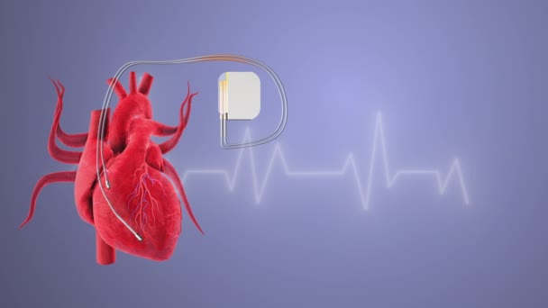 Das Herz Und Ein Herzschrittmacher Mit Herzschlagwellenlinien — Stockvideo