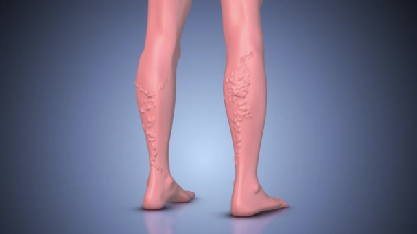 Concept Varicose Veins Venous Insufficiency Vascular Disease Leg — Stock Video