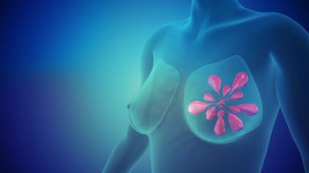 Εννοιολογική Απεικόνιση Του Καρκίνου Του Μαστού — Αρχείο Βίντεο