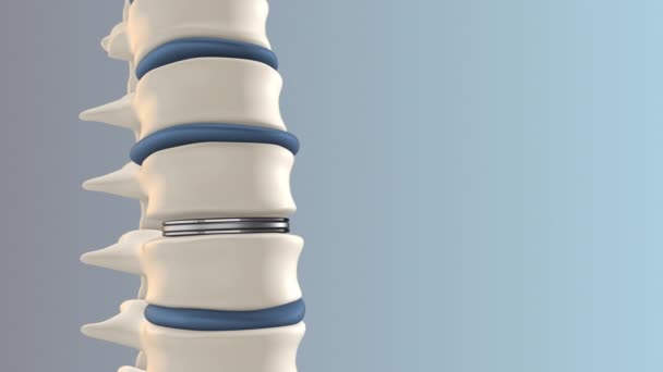 ルーバー脊椎における人工ディスク交換 — ストック動画