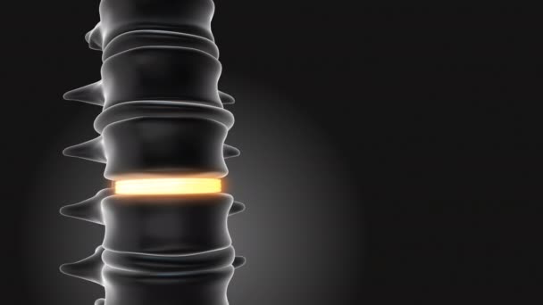Implanty Lędźwiowe Stabilizują Kręgosłup — Wideo stockowe