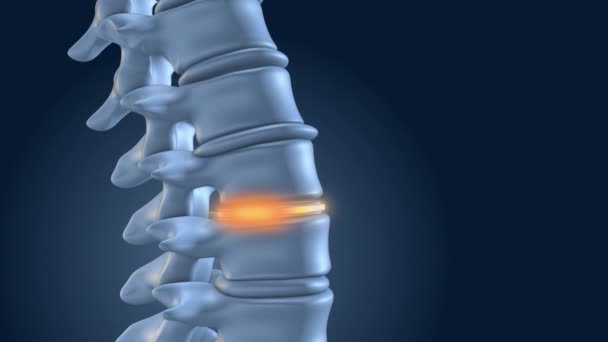 Spine Stabilized Lumbar Implants — Stock Video