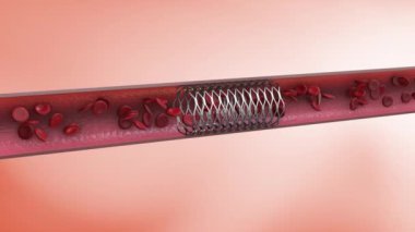 Koroner stent implantasyonu.