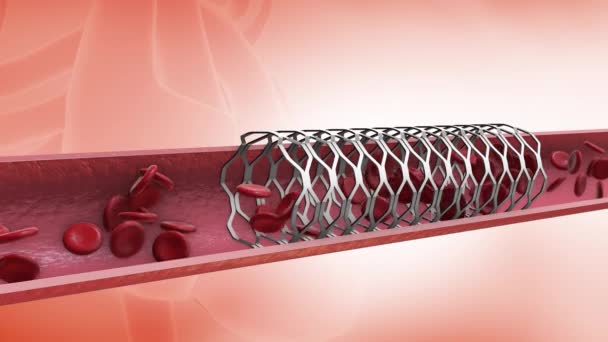 Medizinisches Konzept Der Koronaren Angioplastik Stent Insertion — Stockvideo