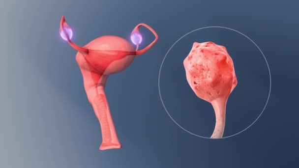 卵巢癌是一种已经扩散到输卵管 子宫或子宫的卵巢癌 — 图库视频影像