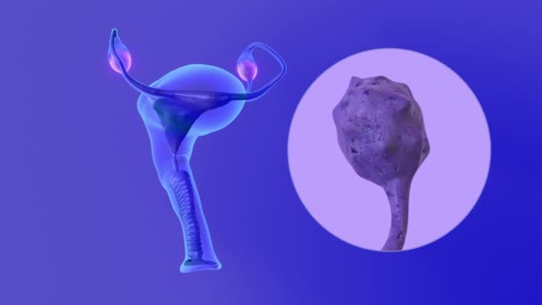 Pcos Uterusa Fallop Tüplerine Veya Rahim Içine Yayılmış Bir Yumurtalık — Stok video
