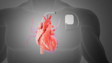 Heart with implanted pacemaker system clipart