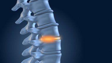 Omurga bel implantlarıyla sabitlendi.