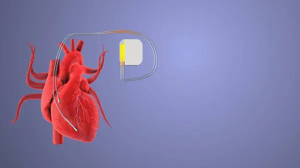 Cardiac pacemaker heartbeat wave linesrt