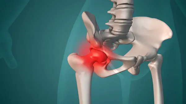 İnsan acılı kalça medikal konsepti