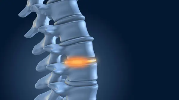 Omurga bel implantlarıyla sabitlendi.