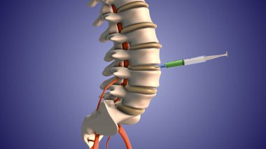 Disk ağrısını tedavi etmek için steroid enjekte ediyorum.