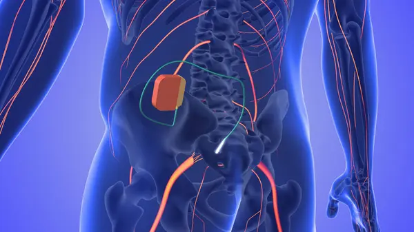 Sacral sinir stimülasyonu tıbbi konsepti