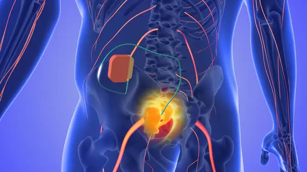 Sacral sinir stimülasyonu tıbbi konsepti