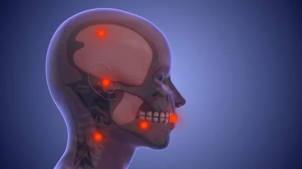 Masticatory ve boyun-omuz mu kas tetikleyici noktalarından kaynaklanan ağrı