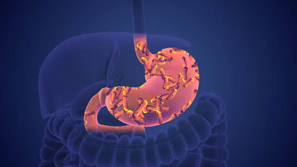 Helicobacter pylori bakterisi mide kanserine neden olur.