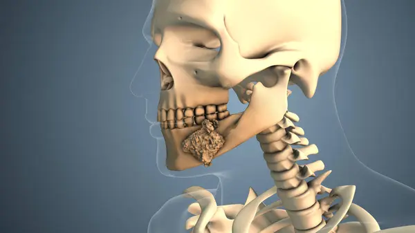 Cancer spreading along a mouth bone
