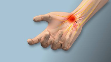 Carpal tunnel syndrome pain, numbness,tingling clipart