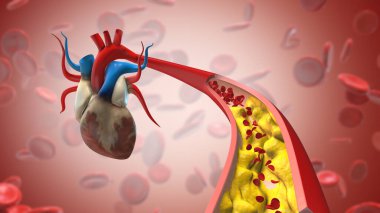 Arterdeki kolesterol plağı kan akışını engelliyor.