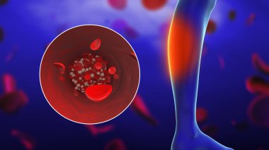 Çevresel ayak ağrısı kavramı ve kan pıhtısı.