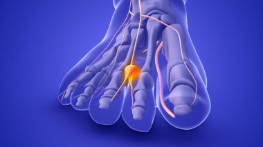 A Morton's neuroma on a foot nerve clipart