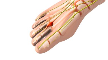A painful neuroma or pinched nerve in the foot clipart