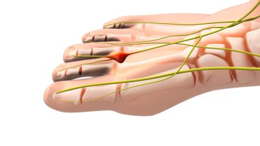 A painful neuroma or pinched nerve in the foot clipart