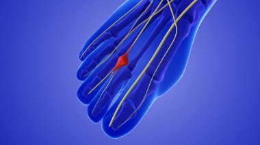 Medical animation of a neuroma or pinched nerve clipart