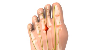 Pinched nerve or neuroma medical animation clipart