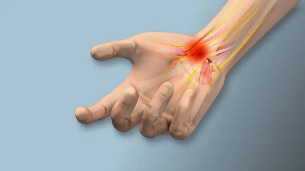 stock image Carpal tunnel syndrome pain, numbness,tingling