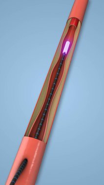 Varisli damar eleme için hassas lazer prosedürü