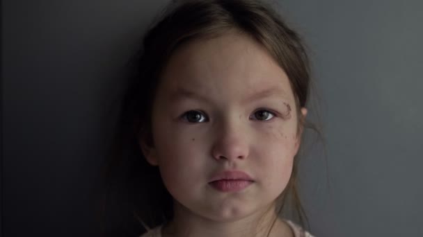 Year Old Girl Has Painful Wound Bruise Her Eye Sad — Stock Video