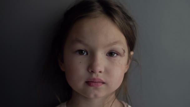 Year Old Girl Has Painful Wound Bruise Her Eye Sad — Vídeo de Stock
