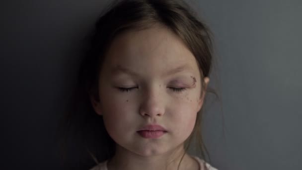 Year Old Girl Has Painful Wound Bruise Her Eye Sad — Stockvideo