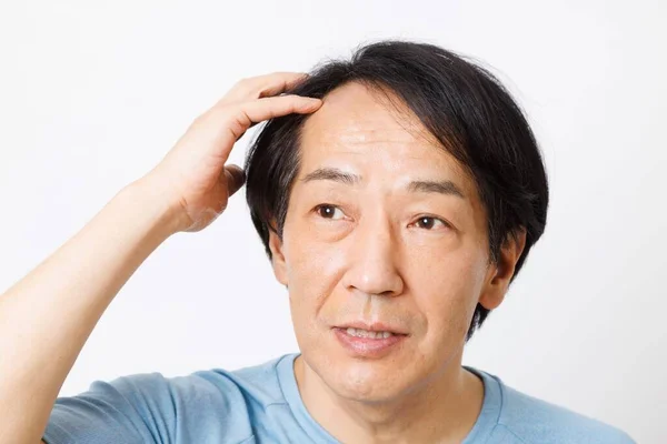 Homme Japonais Mature Avec Problème Perte Cheveux — Photo