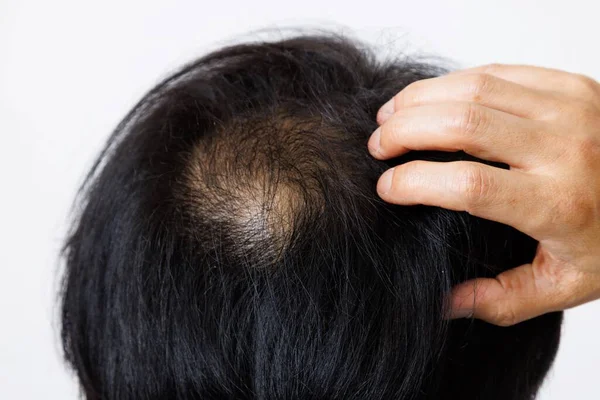 Mature Japanese Man Hair Loss Problem — Stock Photo, Image