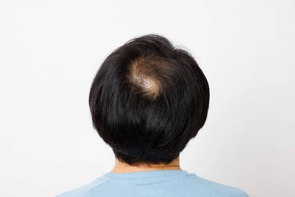 Зрелый Японский Мужчина Проблемой Выпадения Волос — стоковое фото