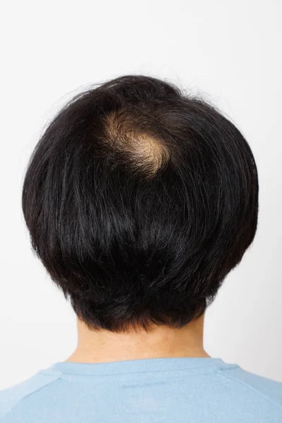 Зрелый Японский Мужчина Проблемой Выпадения Волос — стоковое фото